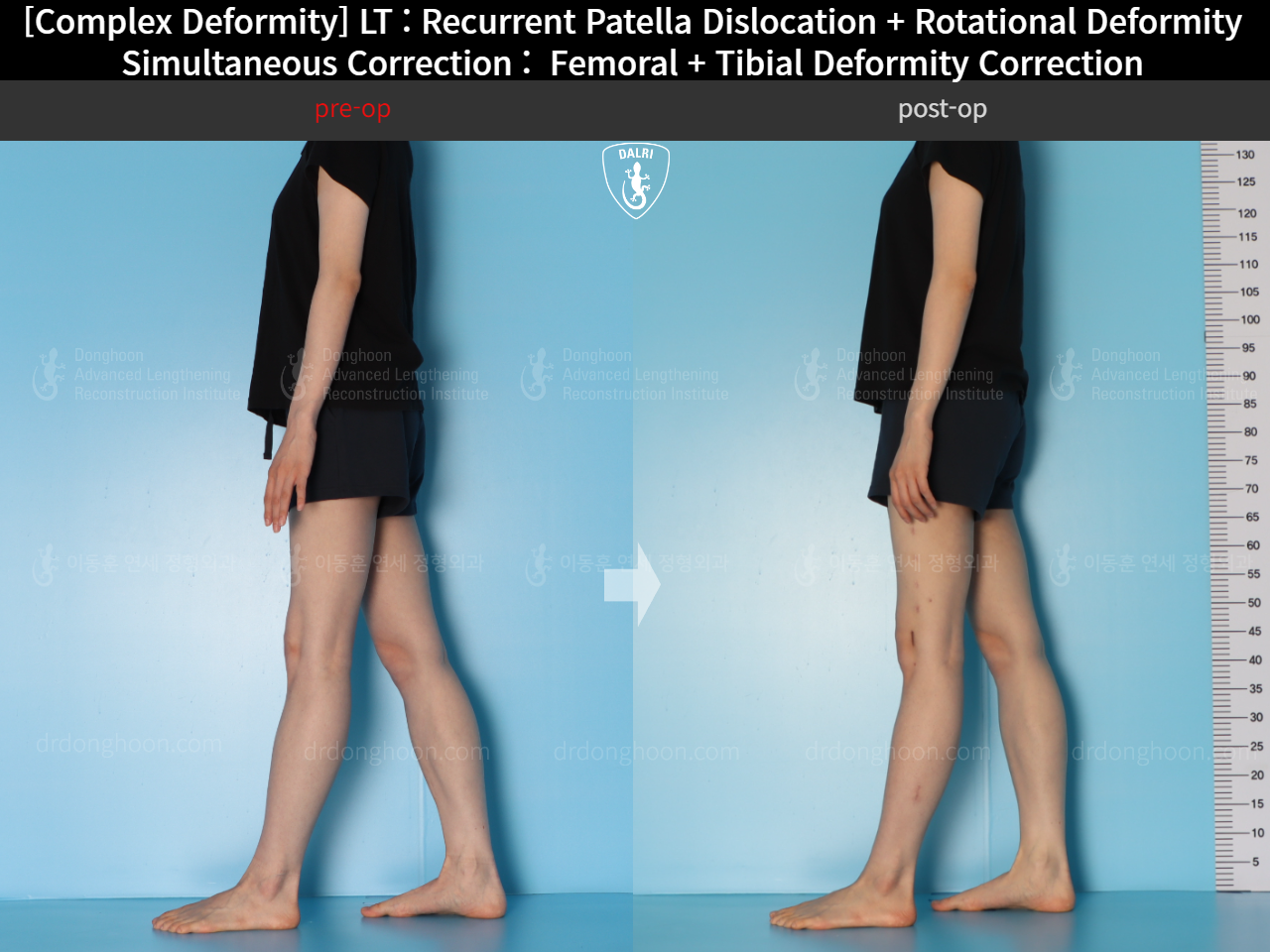 Before and after recurrent patella dislocation, case 18088207, image 9, Dr. Donghoon institute (DALRI)