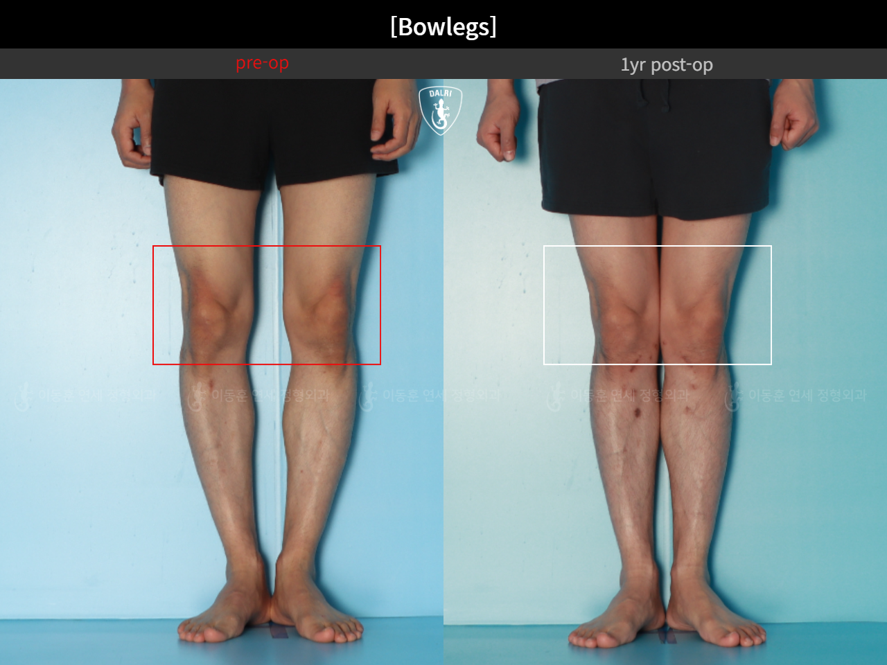Before and after adult bowlegs, case 32564251, image 11, Dr. Donghoon institute (DALRI)