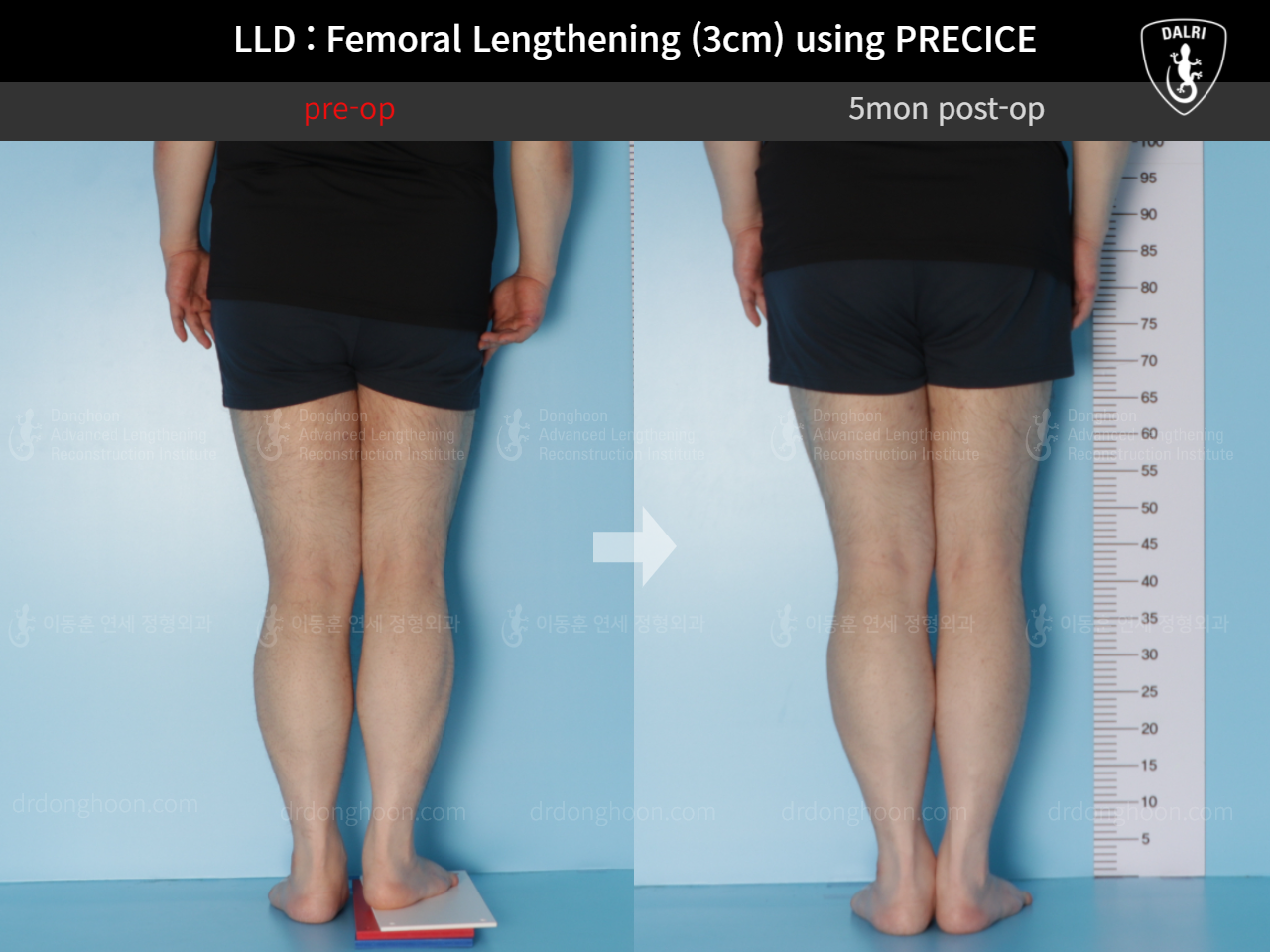 Before and after adult lld, case 5346187, image 6, Dr. Donghoon institute (DALRI)