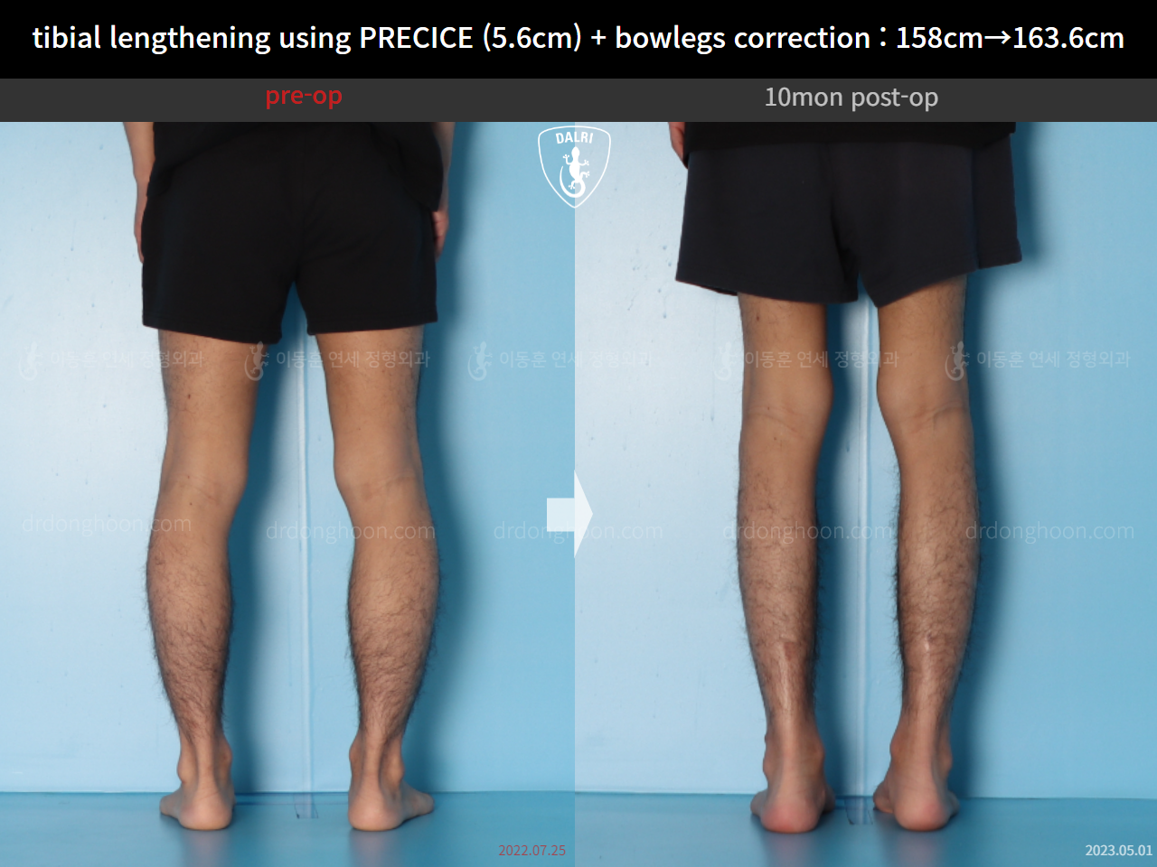 Before and after cll + deformity correction, case 15043777, image 6, Dr. Donghoon institute (DALRI)