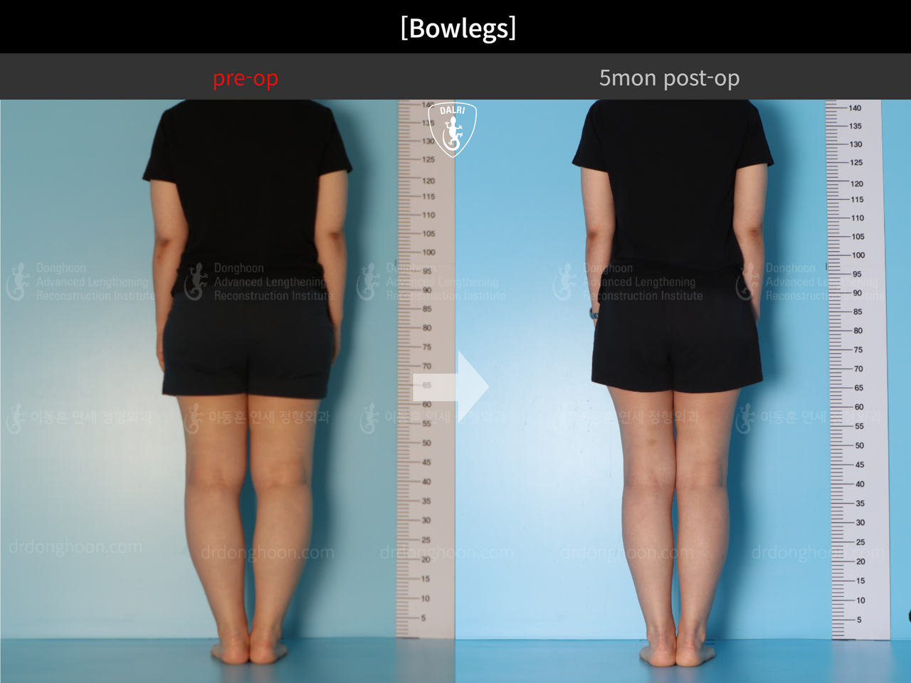 Before and after adult bowlegs, case 13212059, image 5, Dr. Donghoon institute (DALRI)