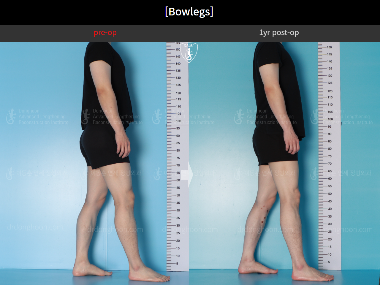 Before and after adult bowlegs, case 16724494, image 6, Dr. Donghoon institute (DALRI)