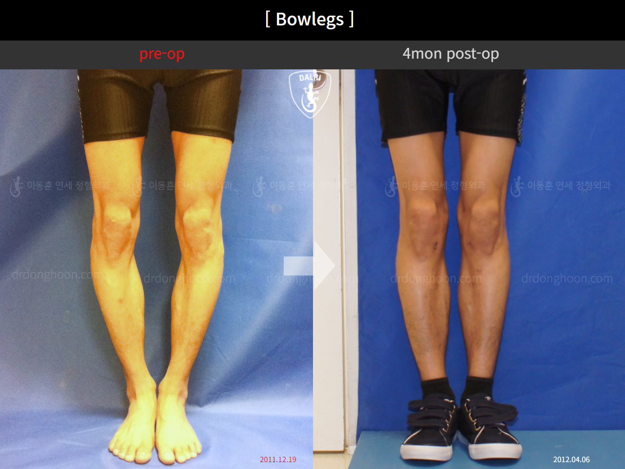 Before and after adult bowlegs, case 11078046, image 1, Dr. Donghoon institute (DALRI)