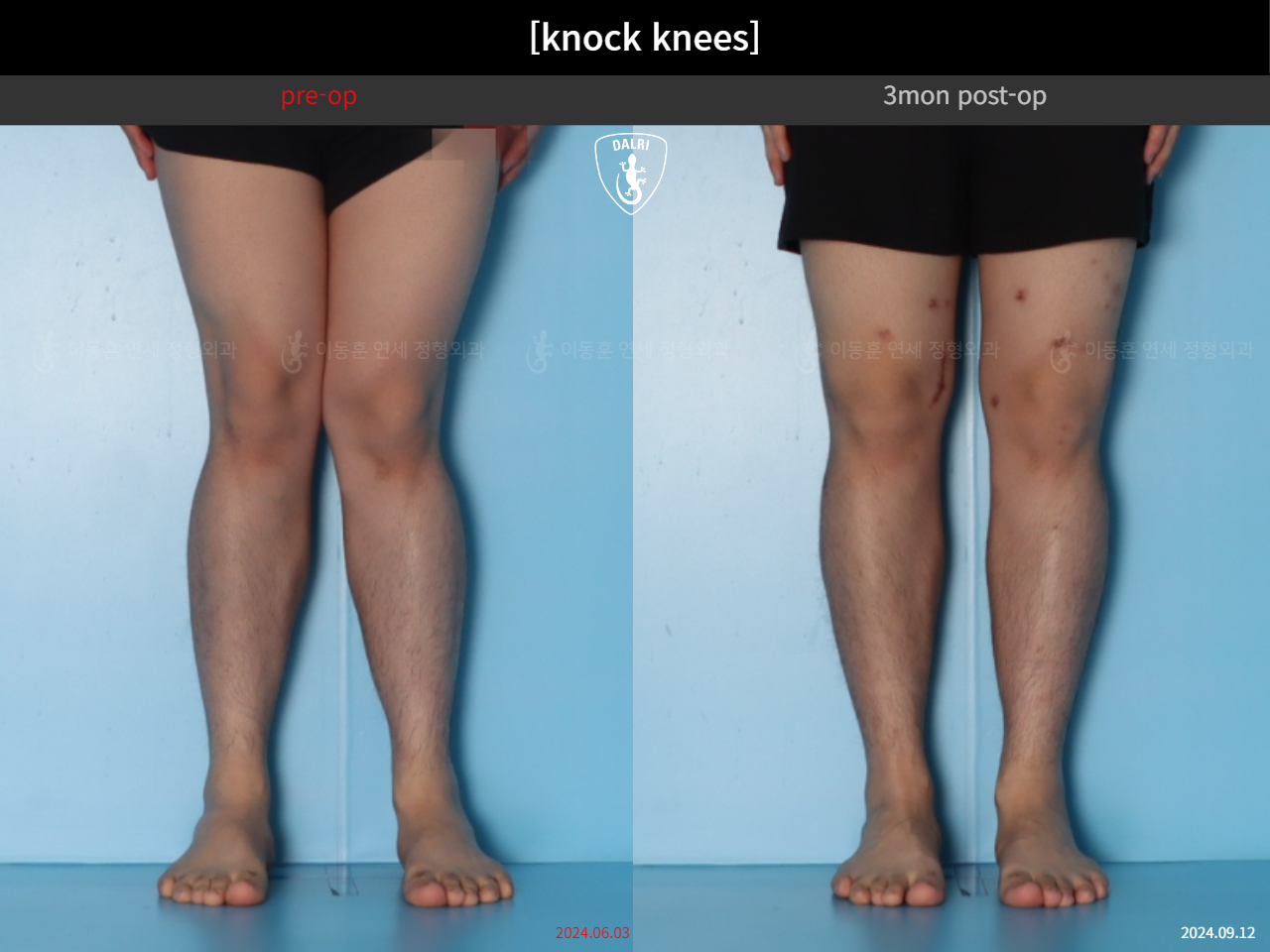 Before and after adult knock knees, case 124642361, image 5, Dr. Donghoon institute (DALRI)