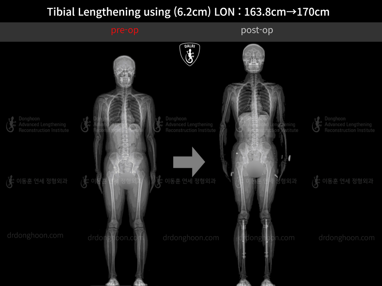 Before and after cll lon, case 13001983, image 9, Dr. Donghoon institute (DALRI)