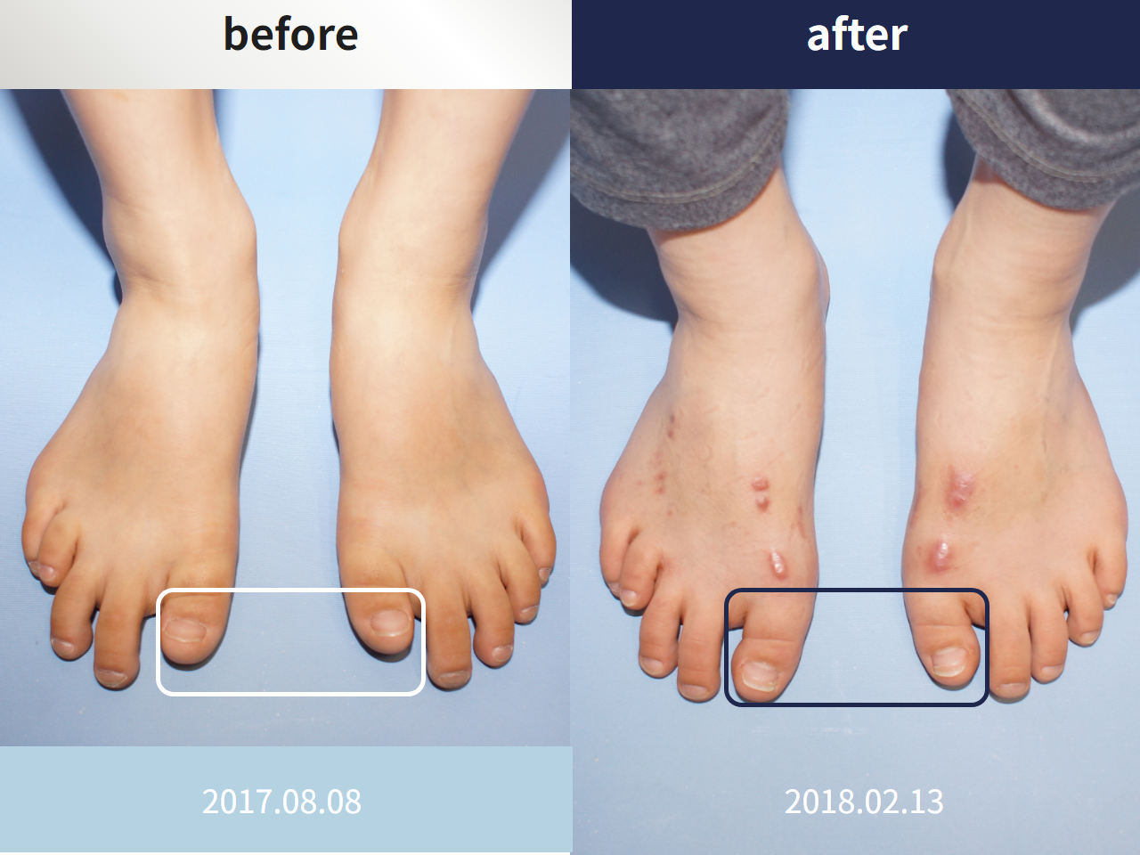 Before and after brachymetatarsia, case 4249076, image 2, Dr. Donghoon institute (DALRI)