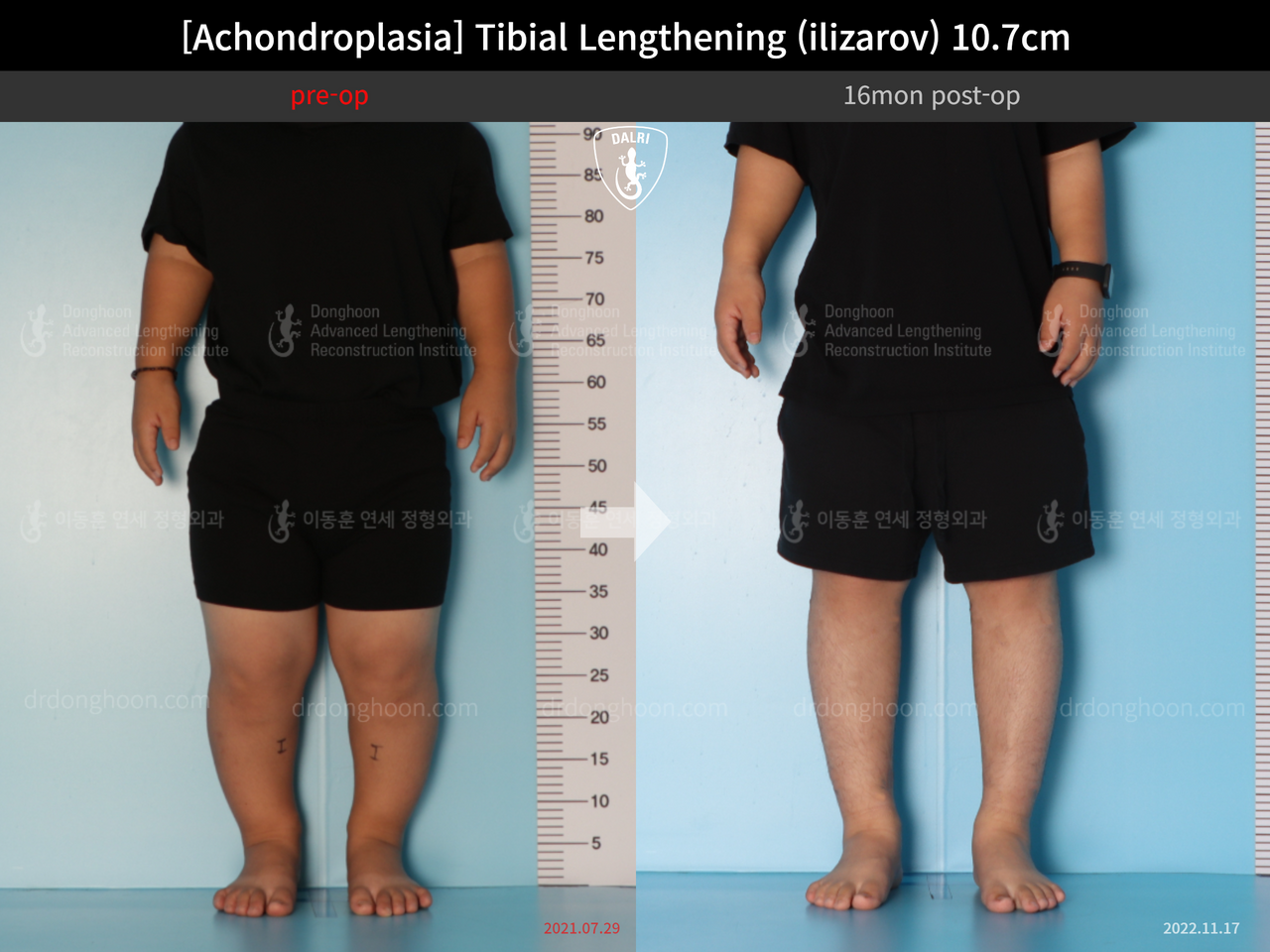 Before and after paediatric congenital condition, case 13489647, image 4, Dr. Donghoon institute (DALRI)