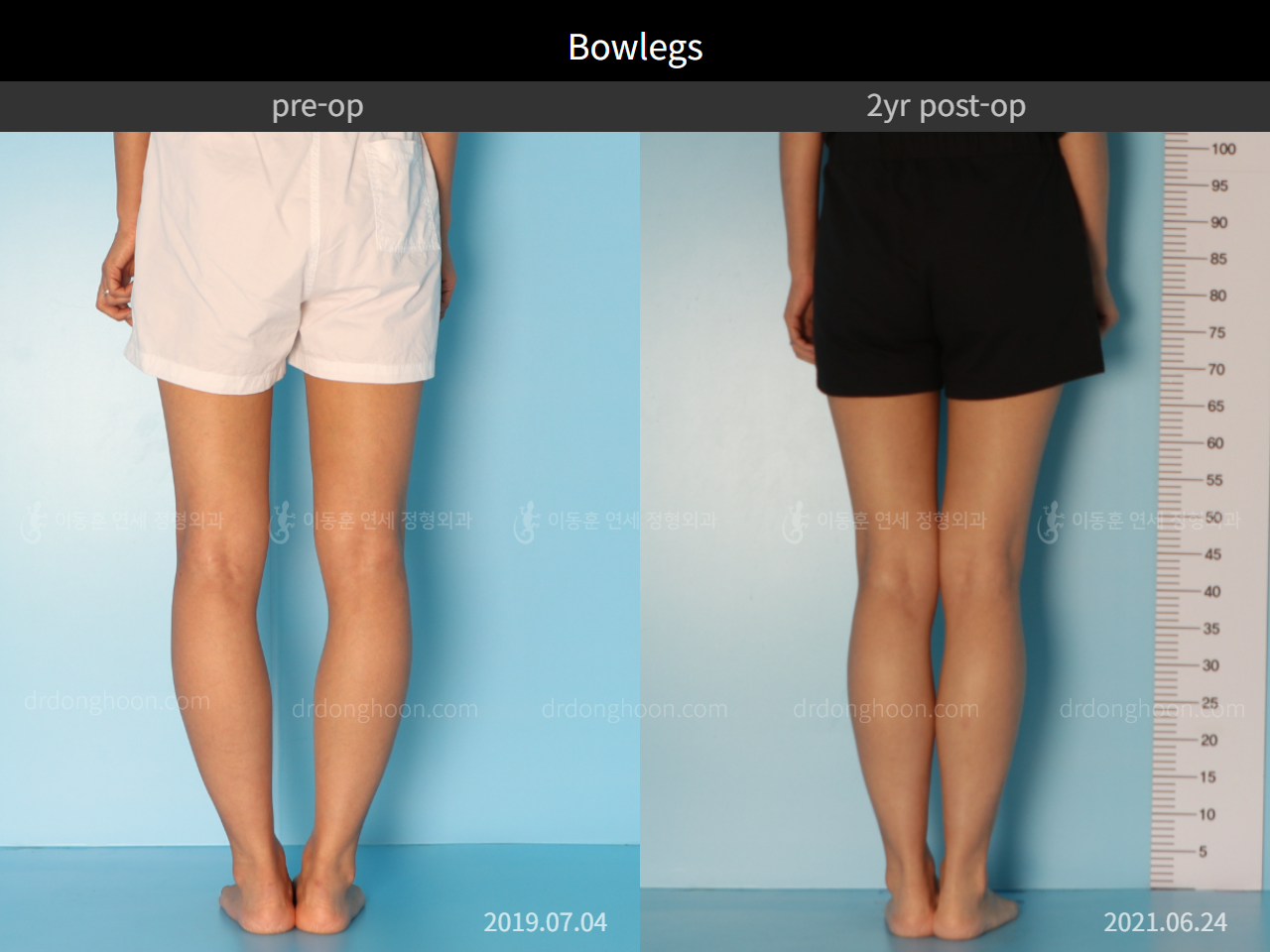 Before and after adult bowlegs, case 7945709, image 2, Dr. Donghoon institute (DALRI)