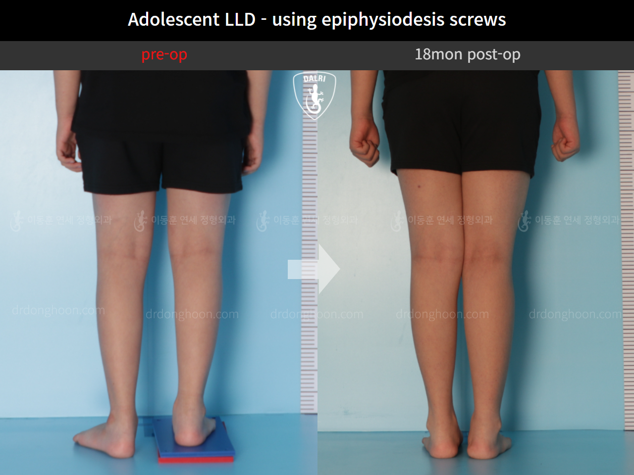 Before and after paediatric & adolescent lld, case 10439770, image 4, Dr. Donghoon institute (DALRI)