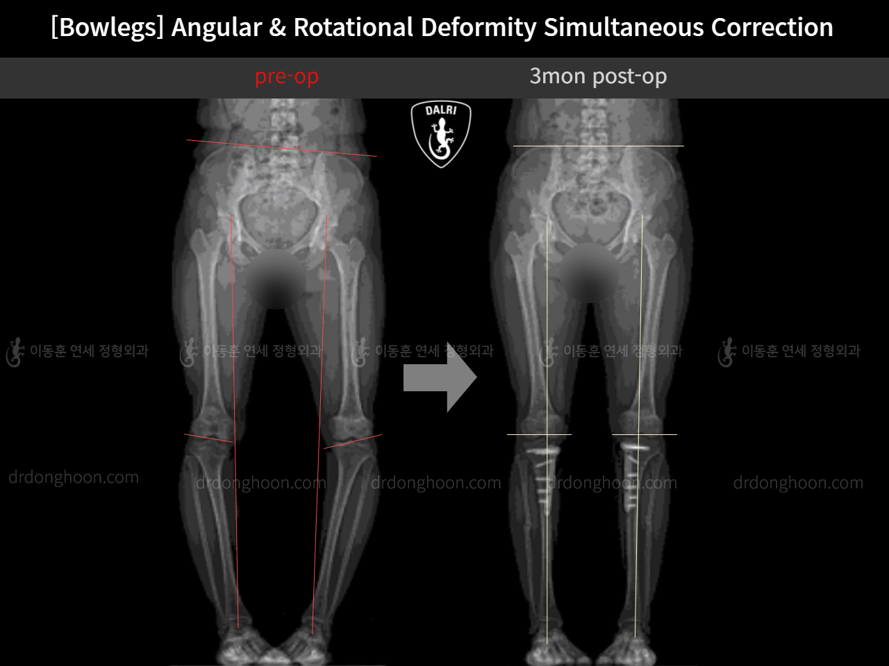 Before and after adult bowlegs, case 11337984, image 3, Dr. Donghoon institute (DALRI)