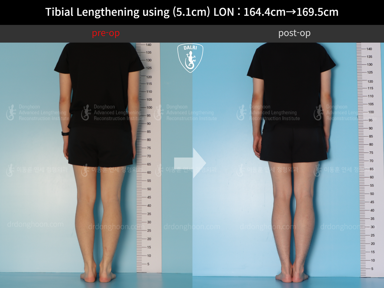 Before and after cll lon, case 12653375, image 2, Dr. Donghoon institute (DALRI)