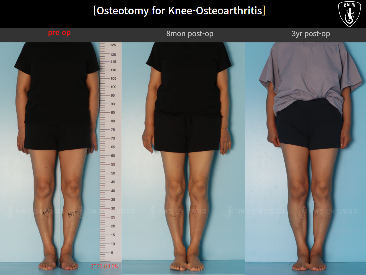 Before and after osteotomy for knee osteoarthritis, case 85842641, image 1, Dr. Donghoon institute (DALRI)