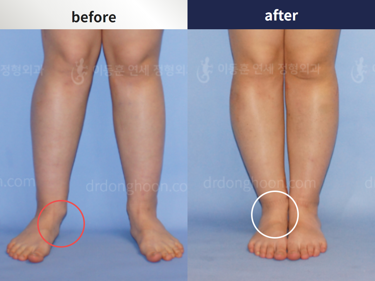 Before and after foot & ankle deformity, case 4248128, image 1, Dr. Donghoon institute (DALRI)
