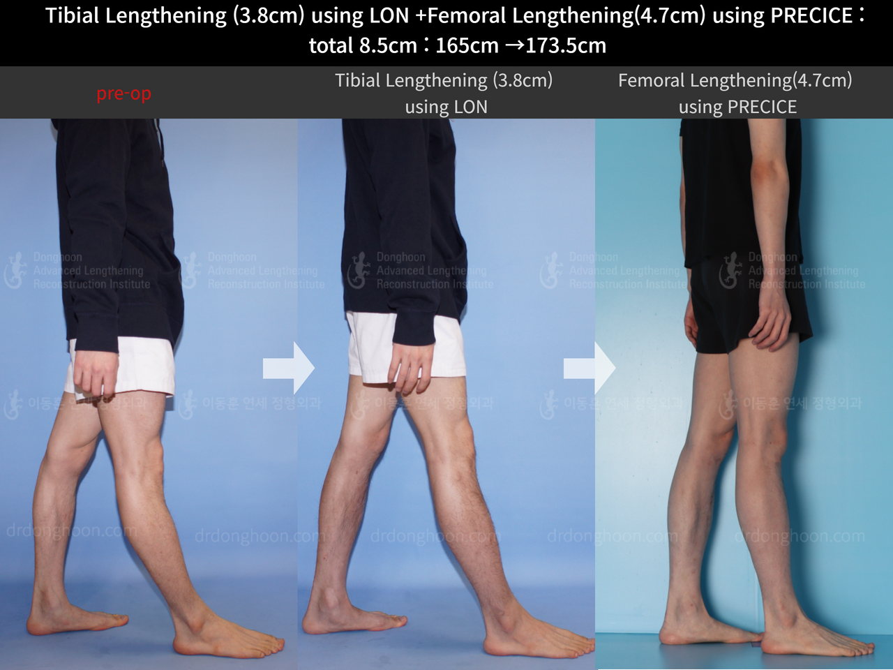 Before and after cll precice, case 4576980, image 3, Dr. Donghoon institute (DALRI)