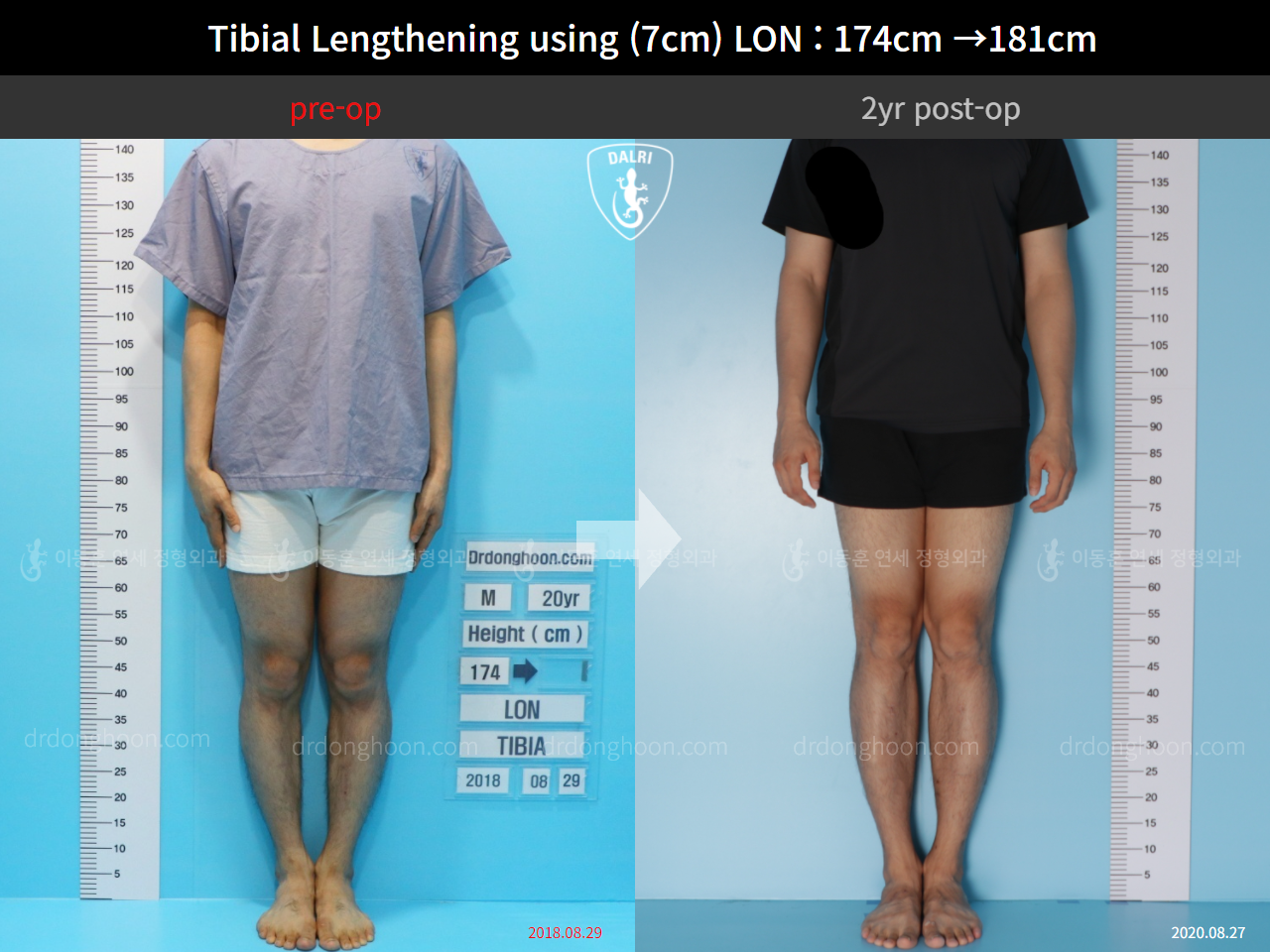 Before and after cll lon, case 5316185, image 1, Dr. Donghoon institute (DALRI)