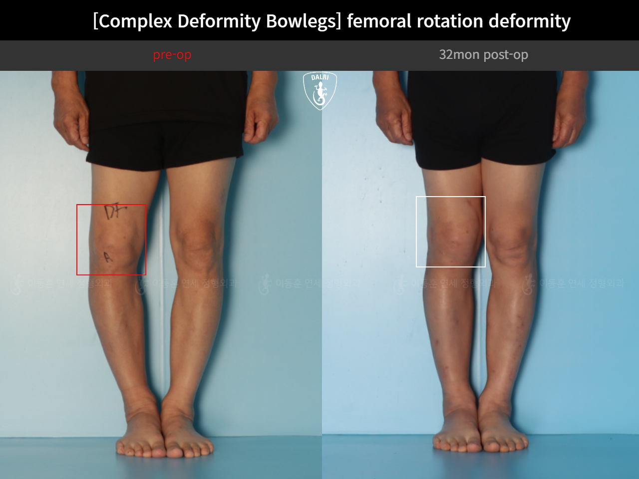 Before and after adult bowlegs, case 35242887, image 9, Dr. Donghoon institute (DALRI)