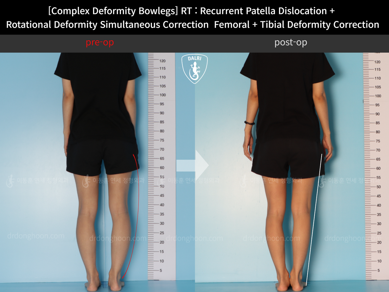 Before and after complex deformity, case 12255273, image 4, Dr. Donghoon institute (DALRI)
