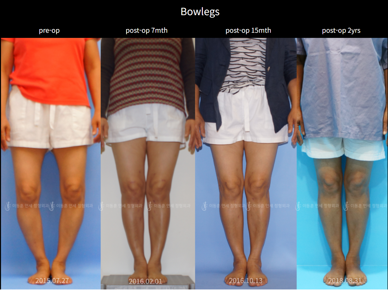 Before and after adult bowlegs, case 6779446, image 1, Dr. Donghoon institute (DALRI)