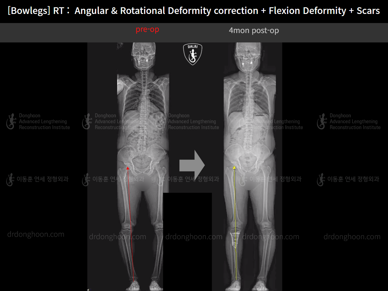 Before and after adult bowlegs, case 14701830, image 11, Dr. Donghoon institute (DALRI)
