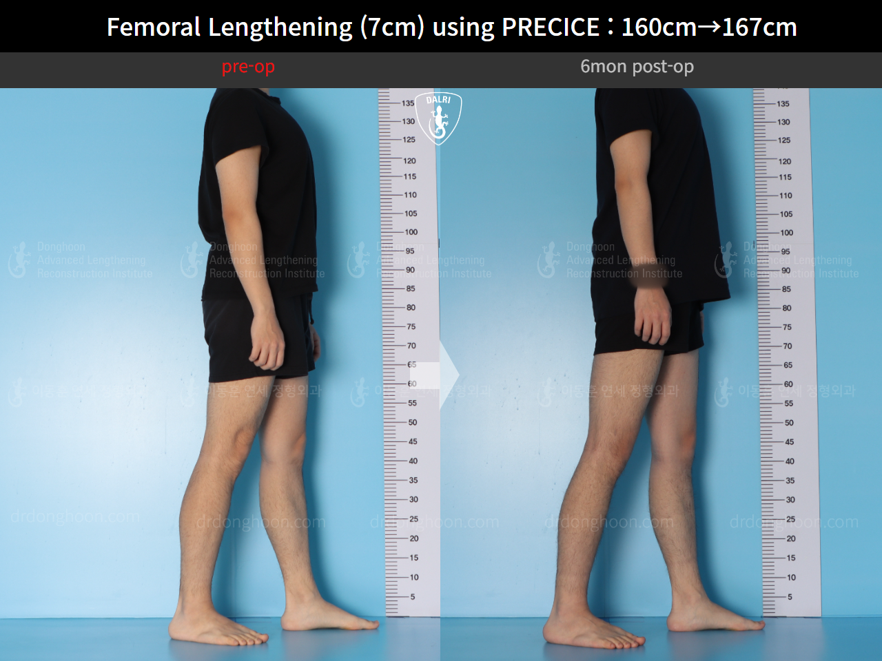 Before and after cll precice, case 15460533, image 8, Dr. Donghoon institute (DALRI)