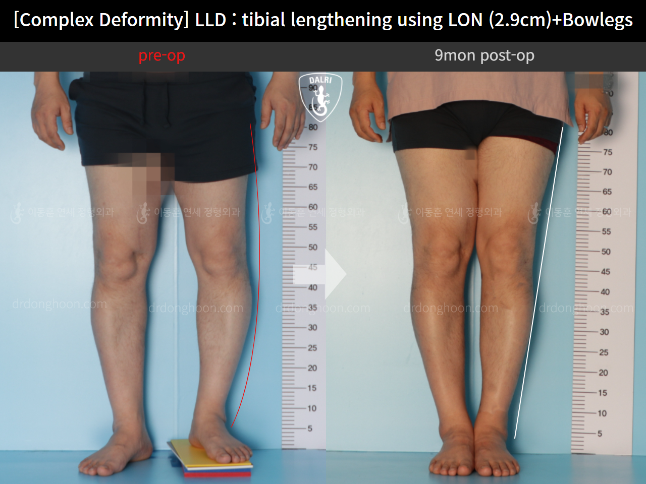 Before and after adult lld, case 11233977, image 4, Dr. Donghoon institute (DALRI)