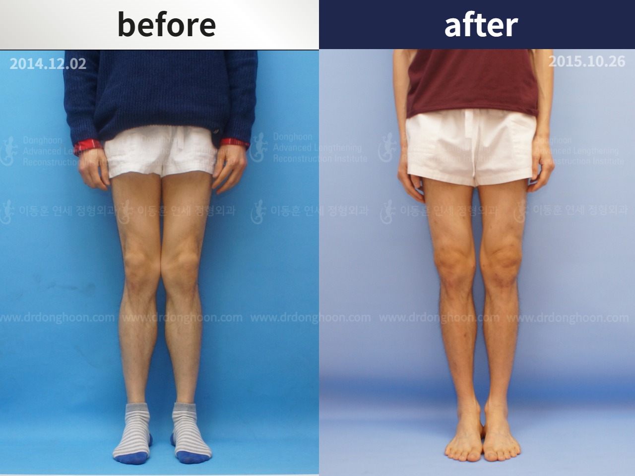 Before and after adult knock knees, case 4640574, image 1, Dr. Donghoon institute (DALRI)