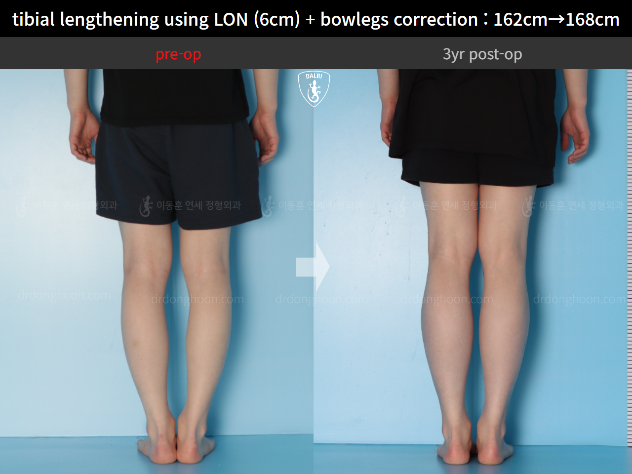 Before and after cll + deformity correction, case 14731799, image 6, Dr. Donghoon institute (DALRI)