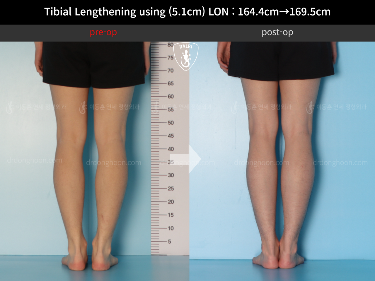 Before and after cll lon, case 12653375, image 6, Dr. Donghoon institute (DALRI)