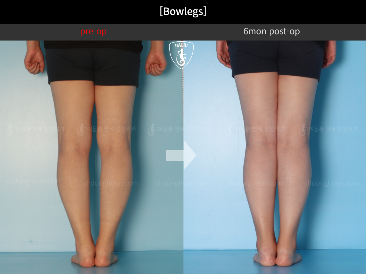 Before and after adult bowlegs, case 12396052, image 7, Dr. Donghoon institute (DALRI)