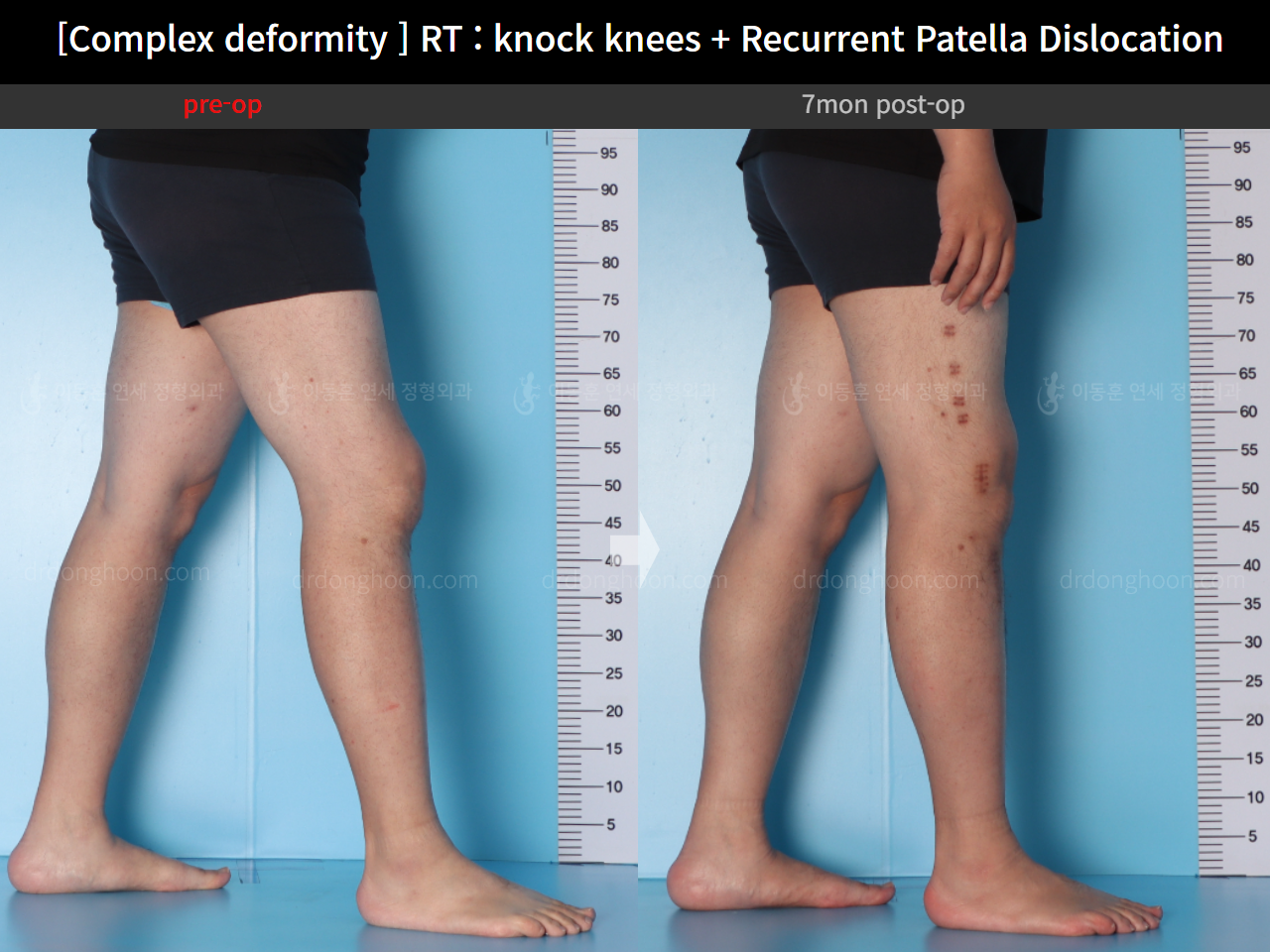 Before and after adult knock knees, case 16147021, image 10, Dr. Donghoon institute (DALRI)