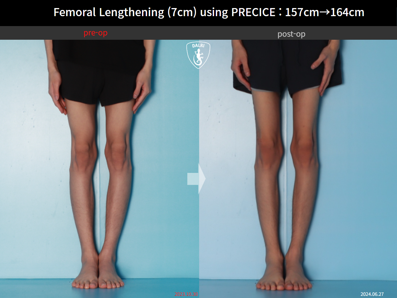 Before and after cll precice, case 31554406, image 7, Dr. Donghoon institute (DALRI)