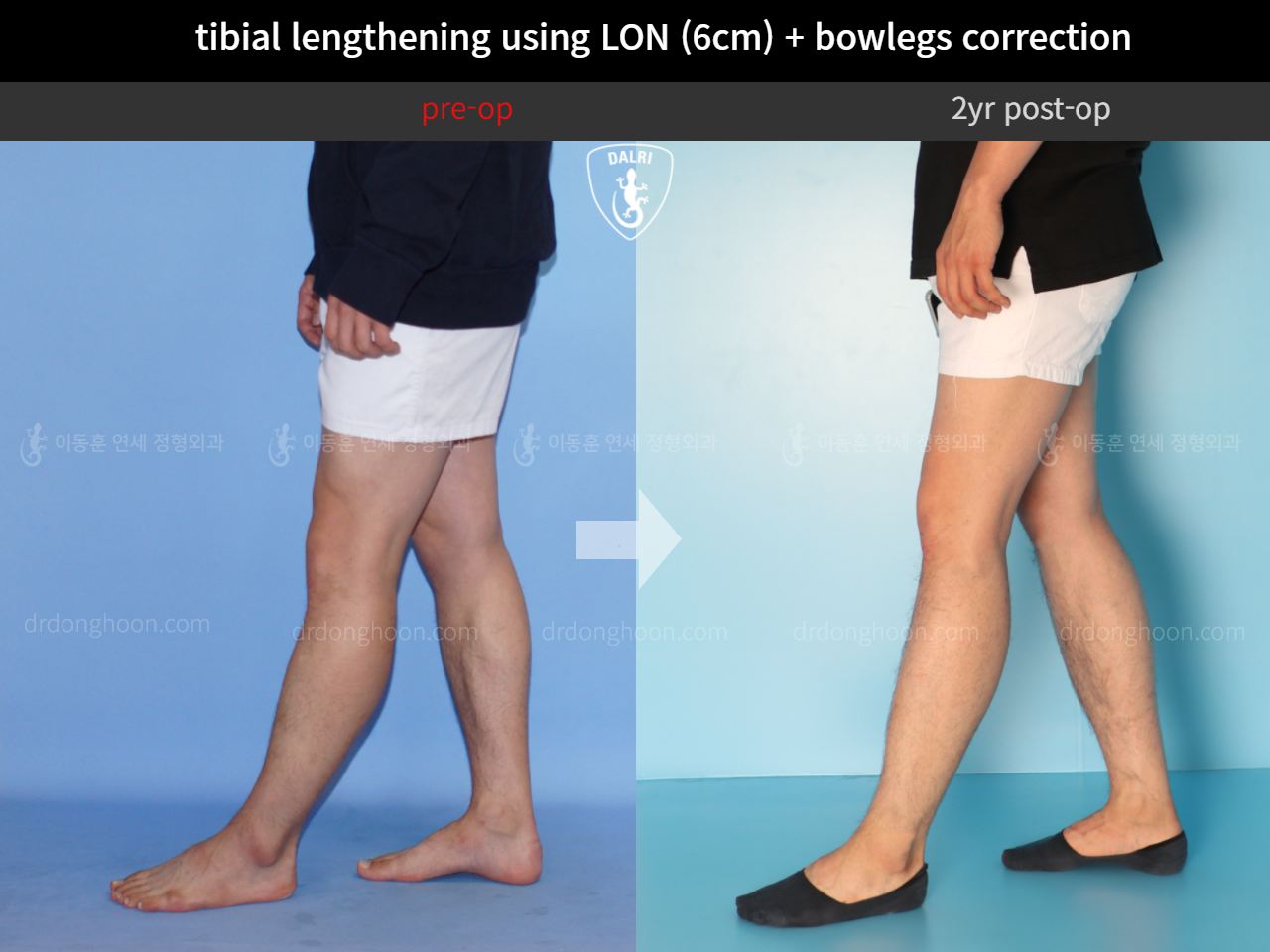 Before and after cll + deformity correction, case 4323155, image 7, Dr. Donghoon institute (DALRI)
