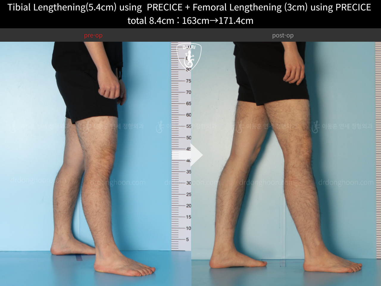 Before and after cll precice, case 12051302, image 10, Dr. Donghoon institute (DALRI)