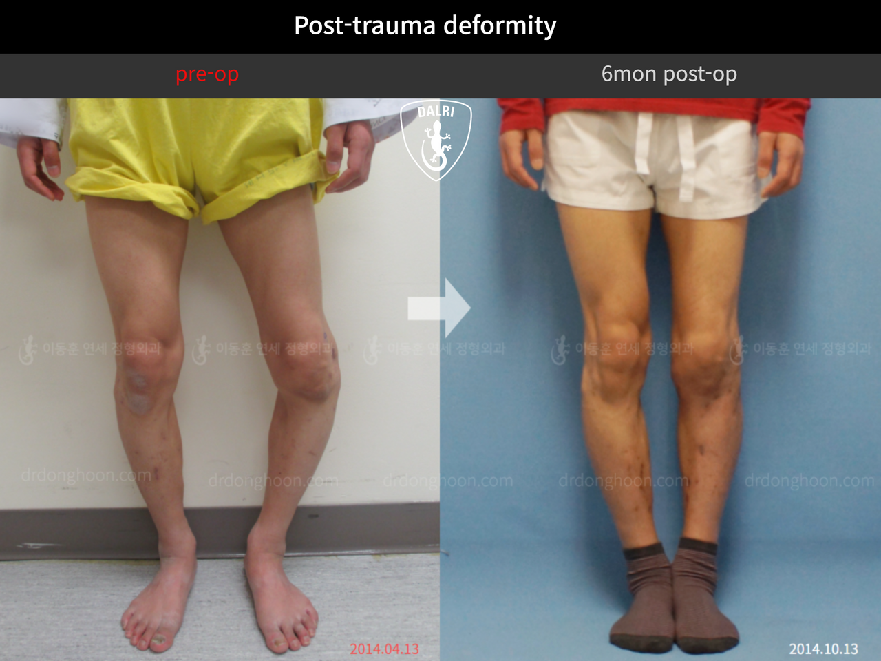 Before and after post-trauma deformity, case 8021097, image 1, Dr. Donghoon institute (DALRI)