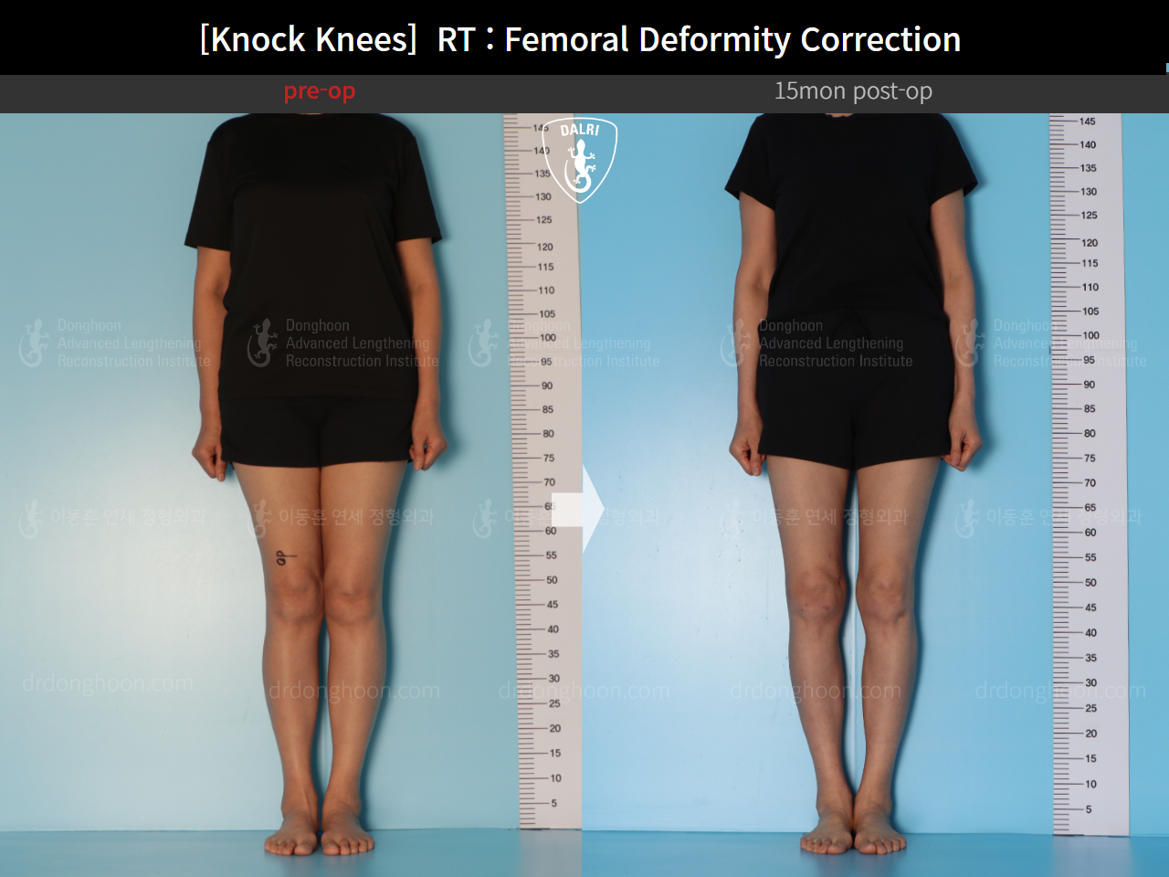 Before and after adult knock knees, case 14462642, image 3, Dr. Donghoon institute (DALRI)