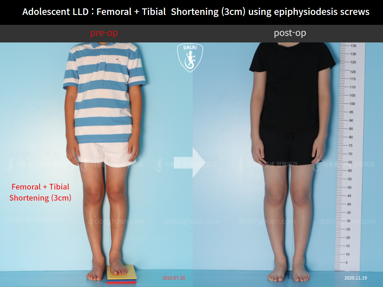 Before and after paediatric & adolescent lld, case 11511257, image 1, Dr. Donghoon institute (DALRI)