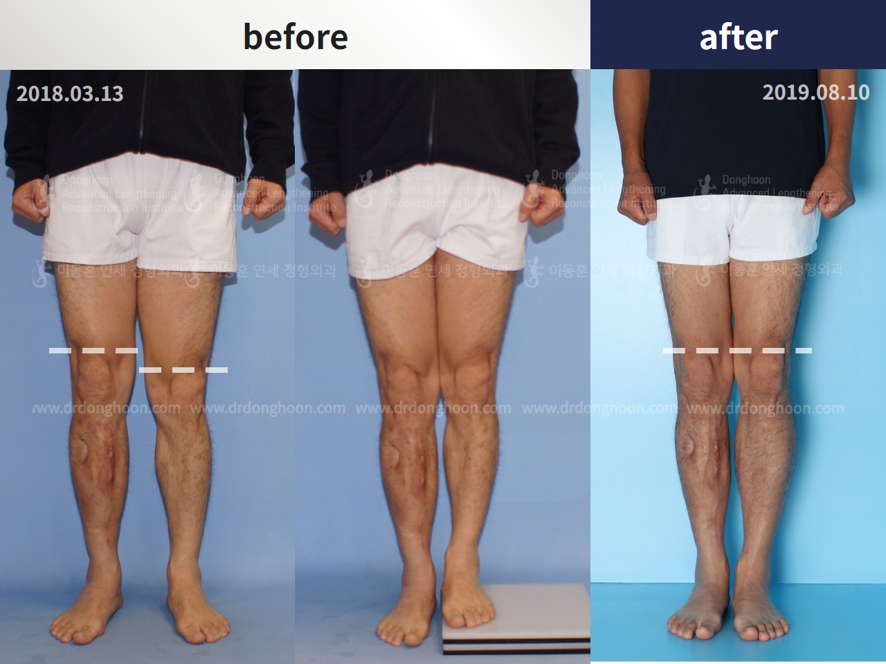 Before and after adult lld, case 4684471, image 1, Dr. Donghoon institute (DALRI)
