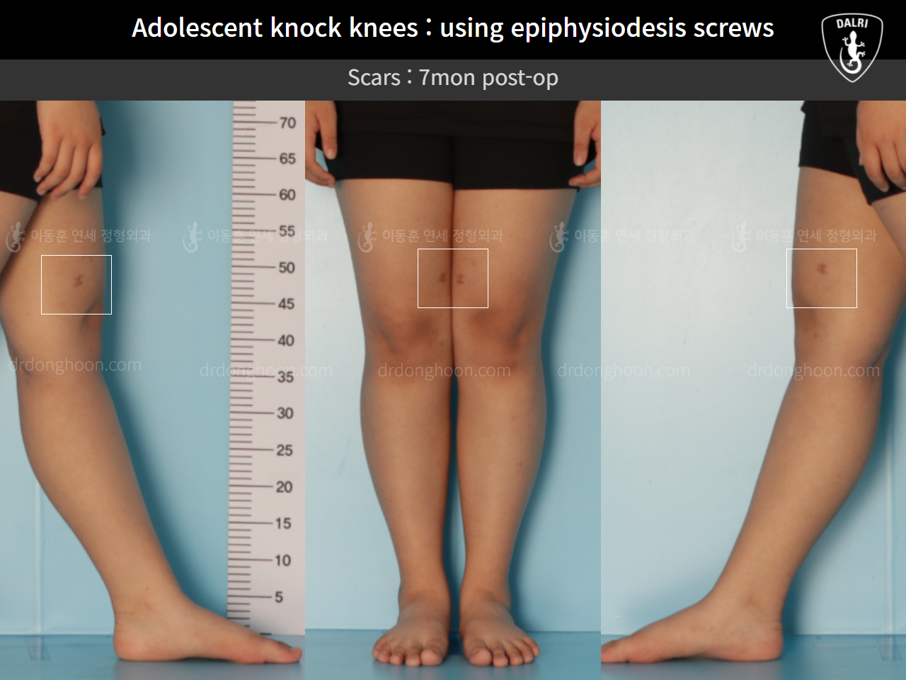 Before and after paediatric & adolescent knock knees, case 11123118, image 7, Dr. Donghoon institute (DALRI)