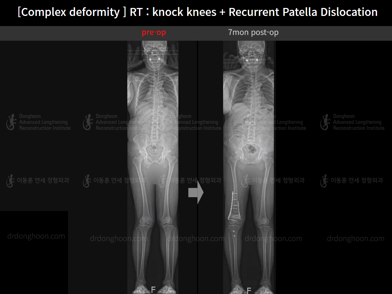 Before and after adult knock knees, case 16147021, image 12, Dr. Donghoon institute (DALRI)