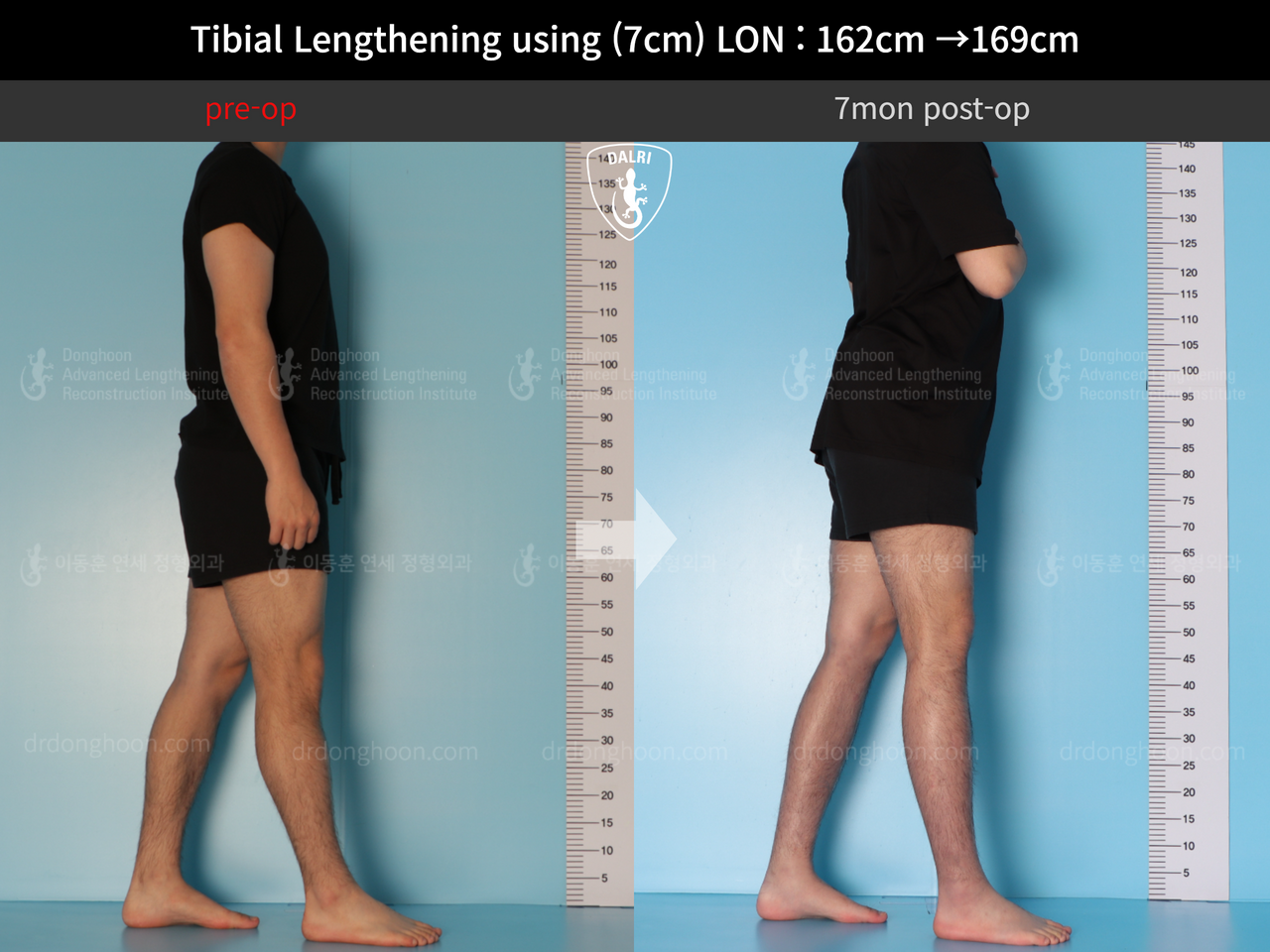 Before and after cll lon, case 13743472, image 5, Dr. Donghoon institute (DALRI)