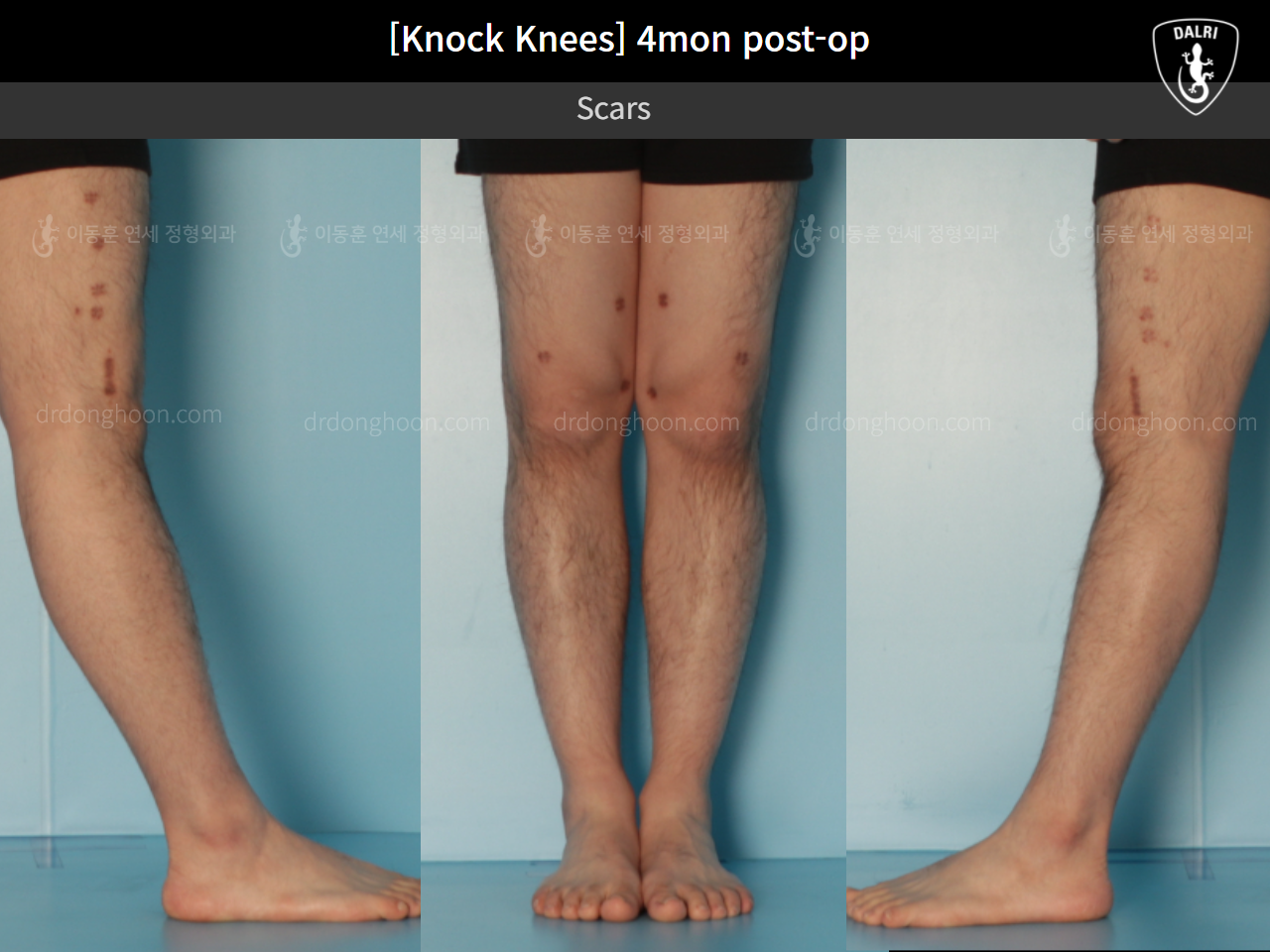 Before and after adult knock knees, case 10599771, image 6, Dr. Donghoon institute (DALRI)