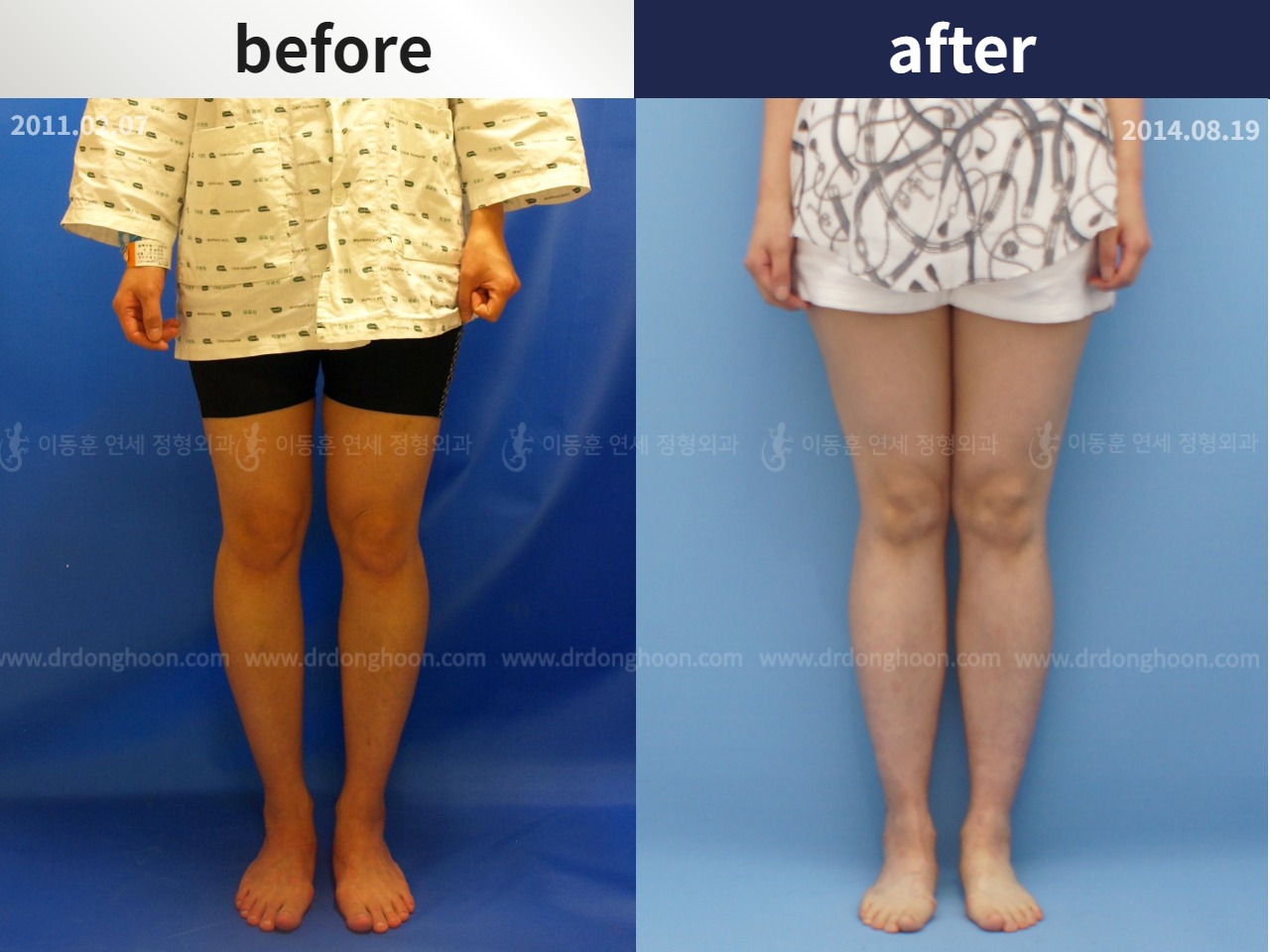 Before and after cll lon, case 4323977, image 2, Dr. Donghoon institute (DALRI)