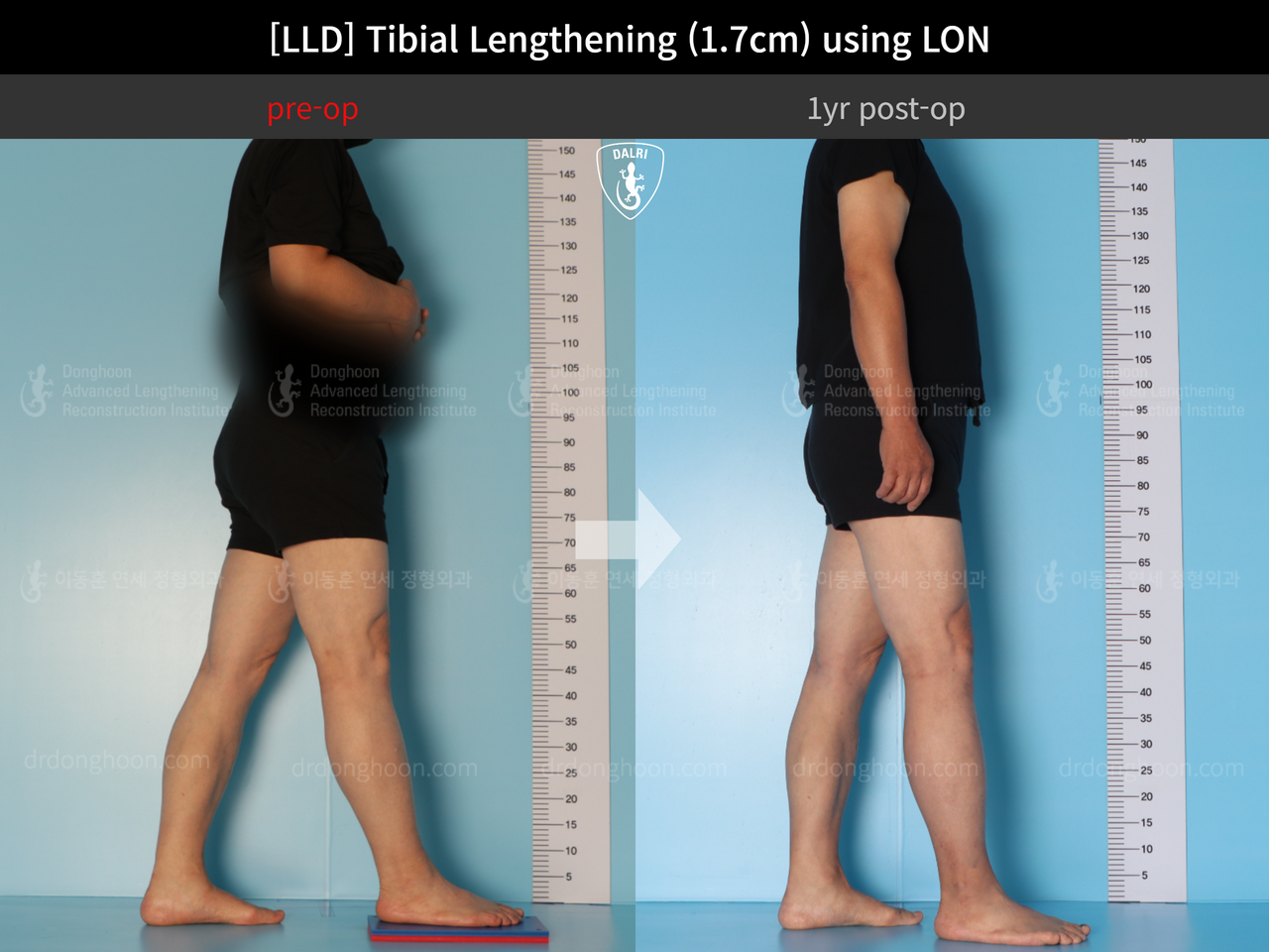 Before and after adult lld, case 13261805, image 3, Dr. Donghoon institute (DALRI)