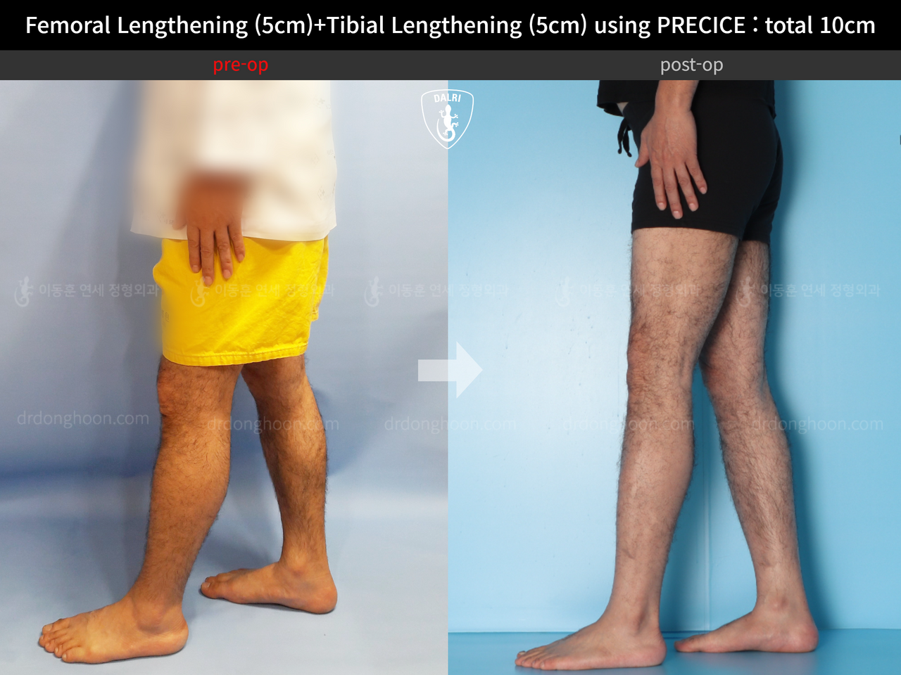 Before and after cll precice, case 13390688, image 7, Dr. Donghoon institute (DALRI)