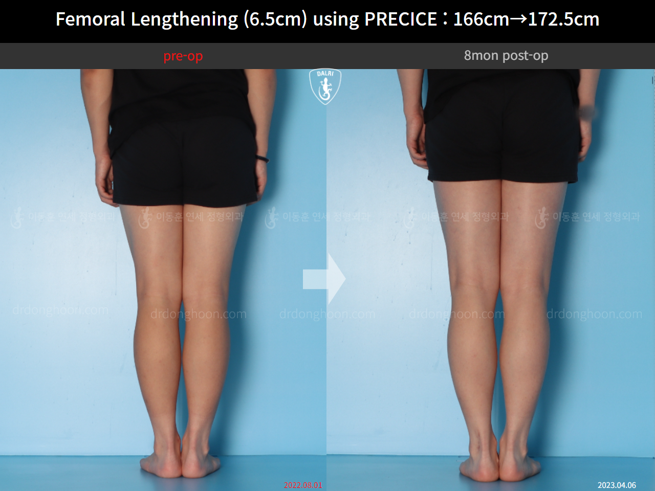Before and after cll precice, case 14706614, image 10, Dr. Donghoon institute (DALRI)