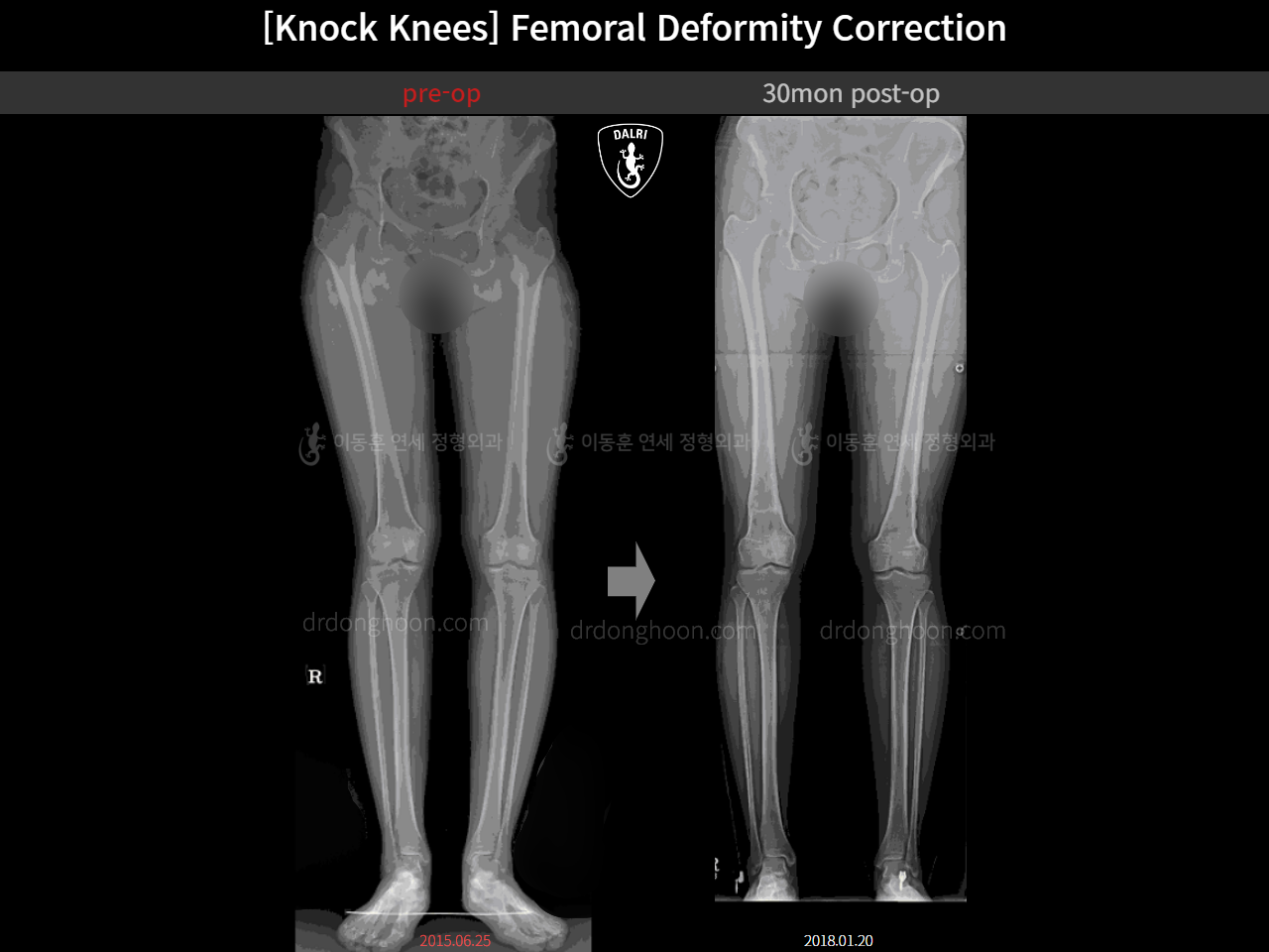 Before and after adult knock knees, case 15674660, image 3, Dr. Donghoon institute (DALRI)