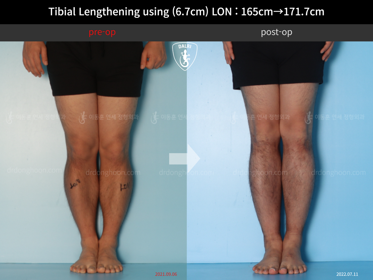 Before and after cll lon, case 12242883, image 3, Dr. Donghoon institute (DALRI)