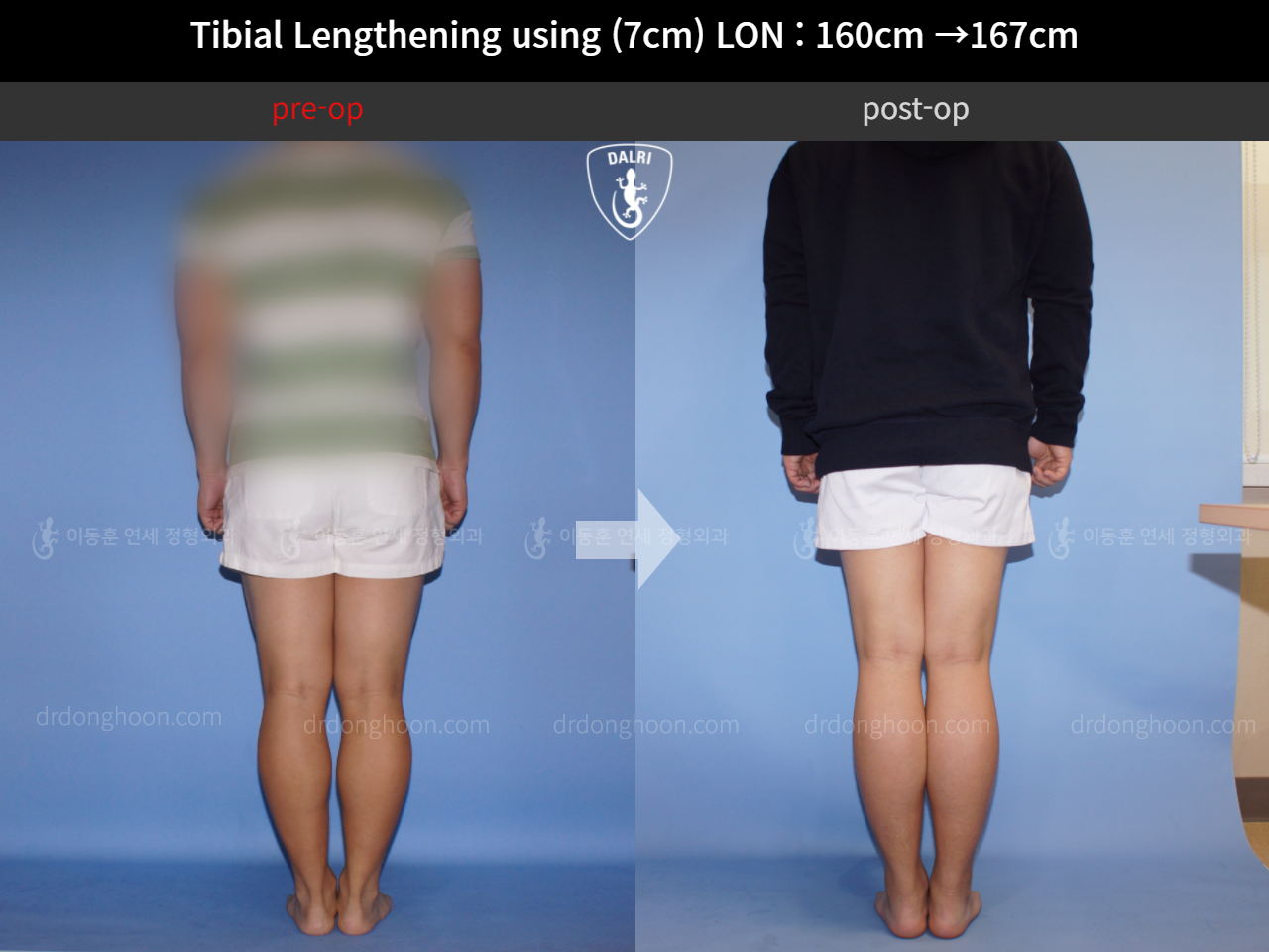 Before and after cll lon, case 11283181, image 2, Dr. Donghoon institute (DALRI)