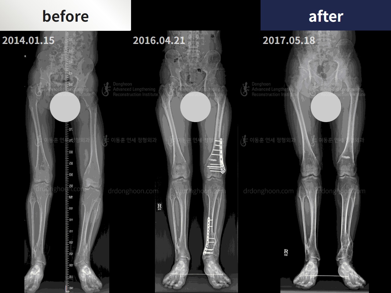 Before and after adult bowlegs, case 4311157, image 3, Dr. Donghoon institute (DALRI)