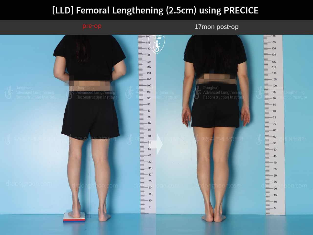 Before and after adult lld, case 18263358, image 2, Dr. Donghoon institute (DALRI)